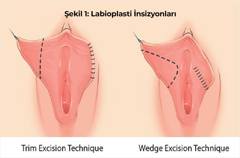 Labioplasti İnsizyonlari