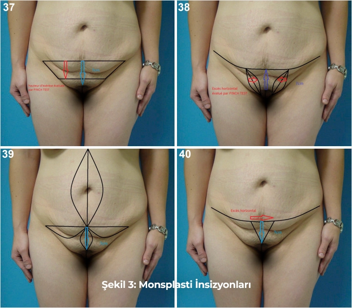 Şekil 3:Monsplasti İnsizyonları