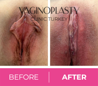 Labiaplasty-clitoral hood reduction