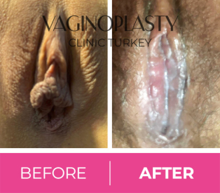 Labiaplasty and clitoral hood reduction post-op