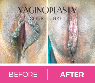 Labiaplasty-clitoral hood reduction-vaginal tightening