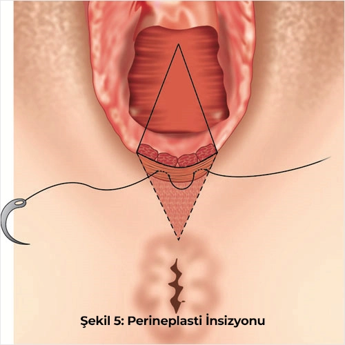 Perinoplasti İnsizyonu